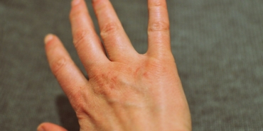Kuru cildi nemlendiren bir kadın eli